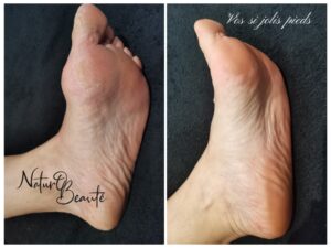 résultat soin des pieds 2